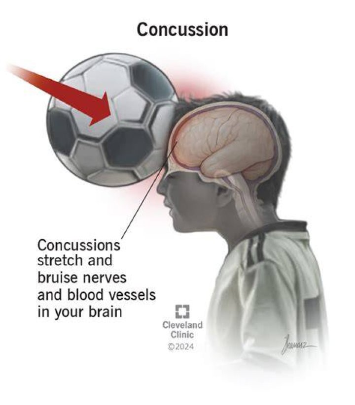 Are concussions common in football?