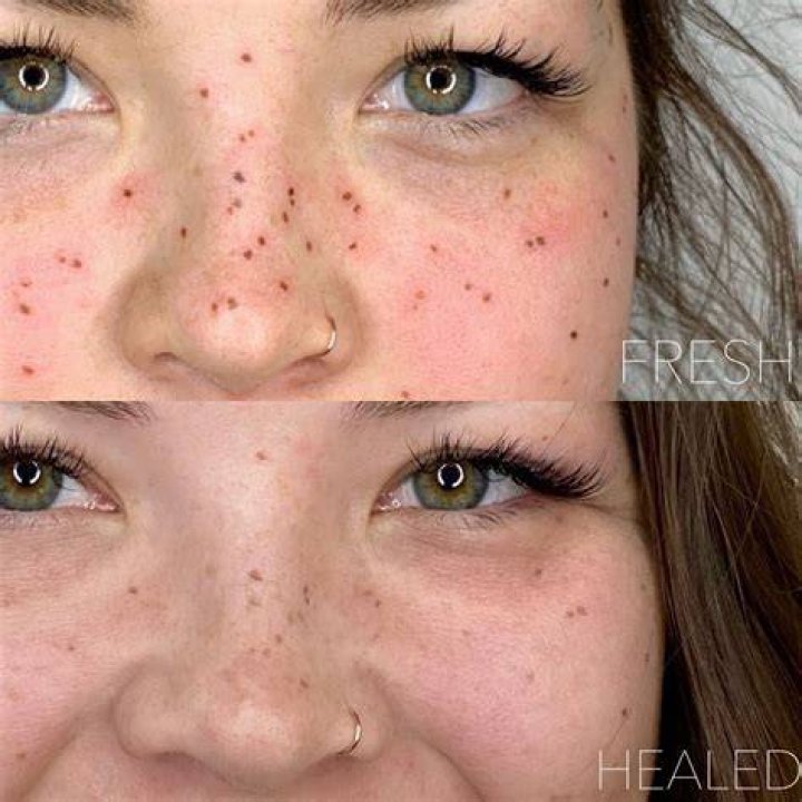 Are freckles permanent?