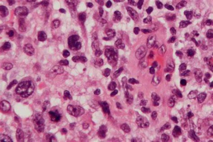 Are lymphoma lumps movable?