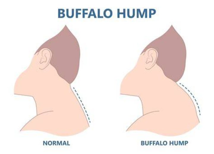 Can a buffalo hump be normal?