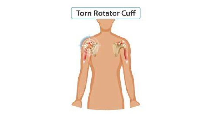 Can a rotator cuff heal on its own?