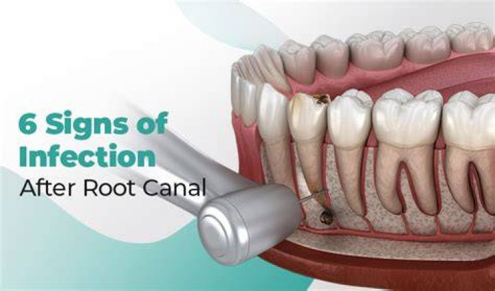 Can a tooth with root canal get infected?