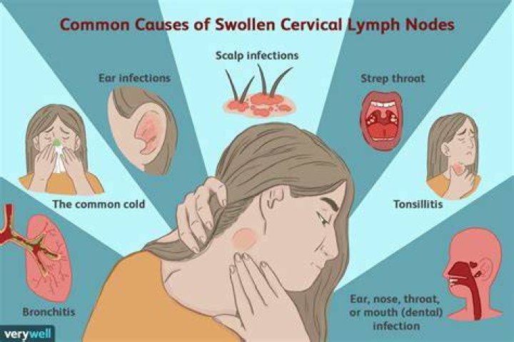 Can allergies cause your lymph nodes to swell?
