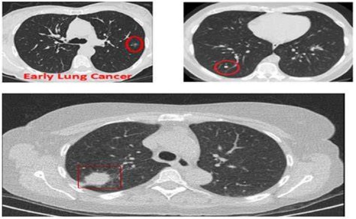 Can an EKG detect lung problems?