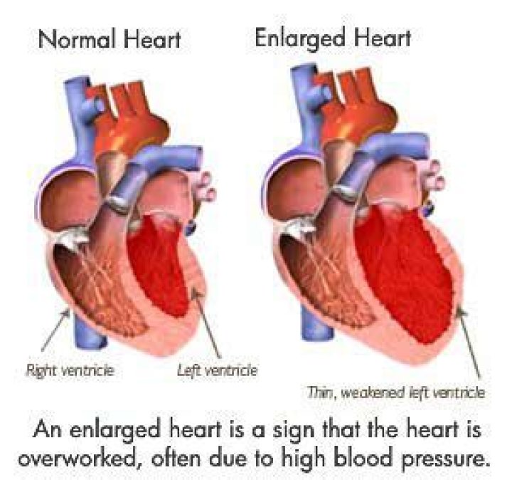 Can an enlarged heart go back to normal?