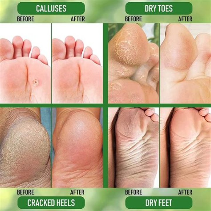 Can calluses go away?