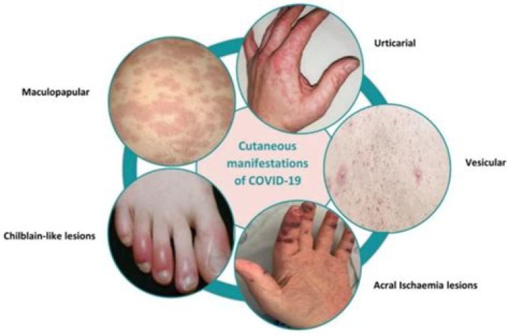 Can Covid trigger psoriasis?
