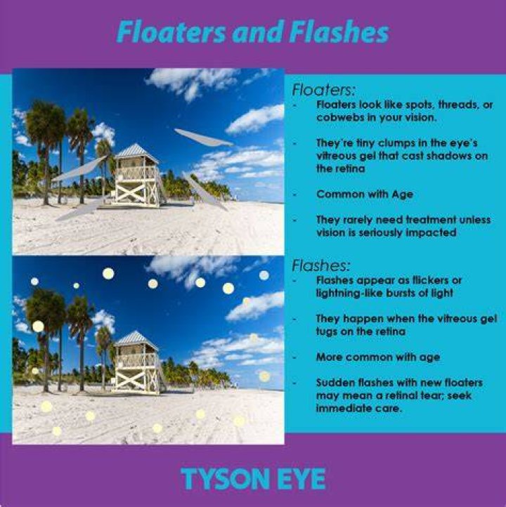 Can eye floaters be cured naturally?