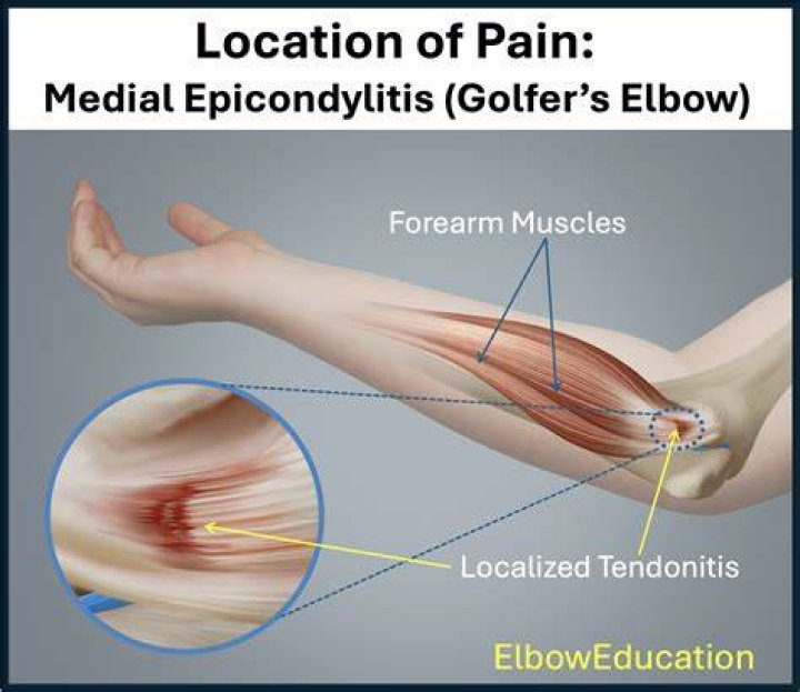 Can golfing make you sore?