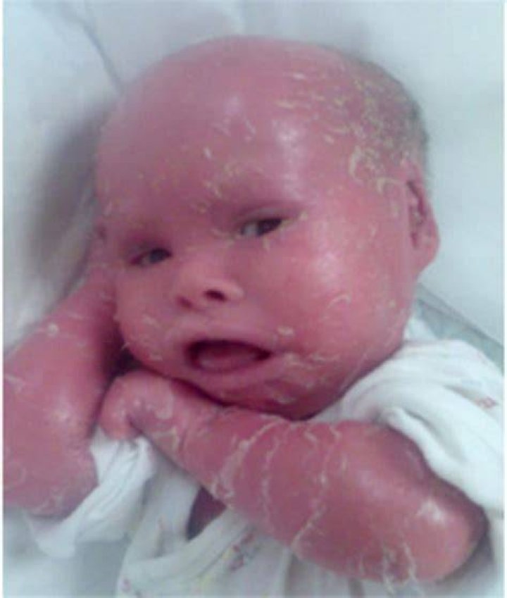 Can ichthyosis go away?