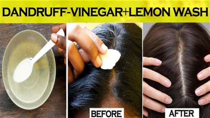 Can Lemon remove dandruff?