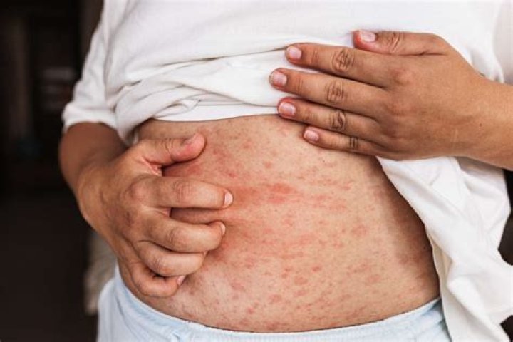 Can you get a rash after COVID?