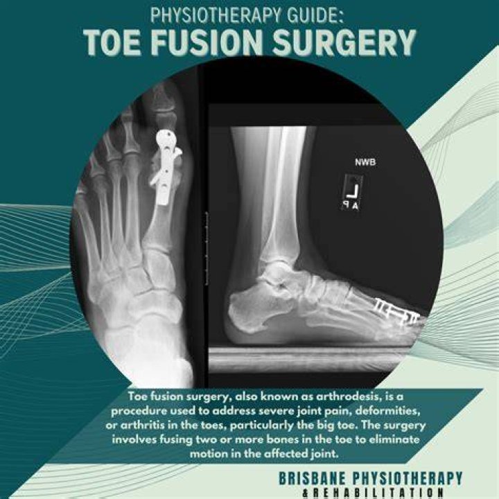 Can you walk after hallux rigidus surgery?