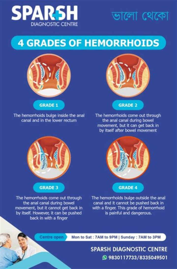 Do Grade 2 hemorrhoids require surgery?