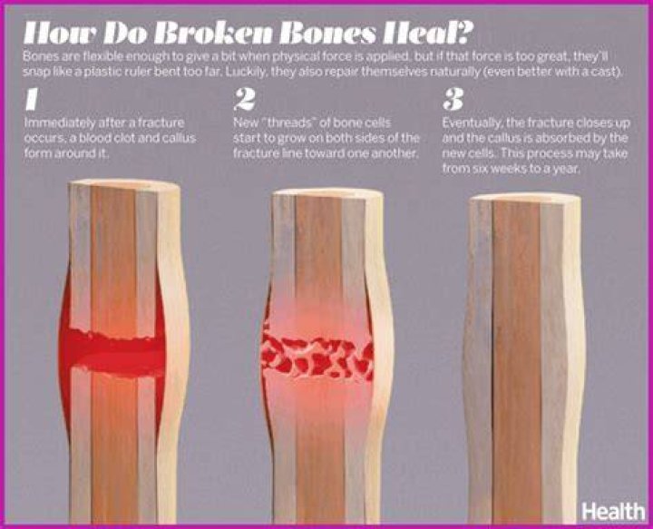 Does a cast heal a broken bone?