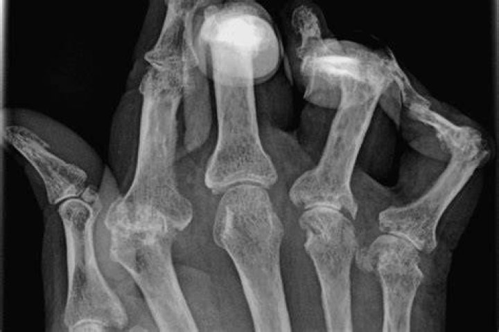 Does an MRI show arthritis?