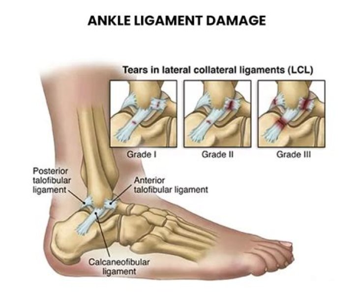 Does ankle ligament tear heal itself?