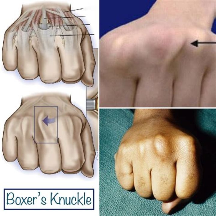 Does boxers knuckle hurt?