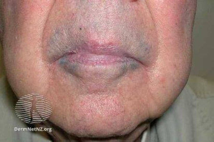 Does burn discoloration go away?
