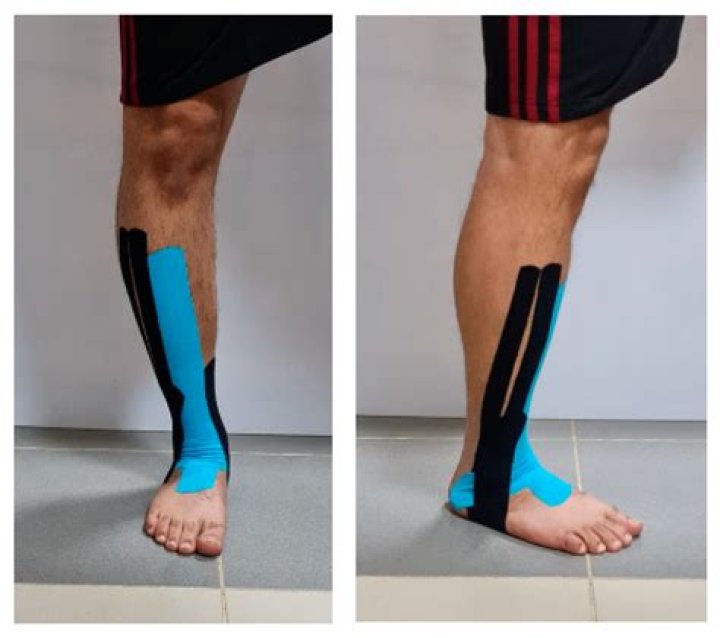 Does Kinesio tape promote healing?