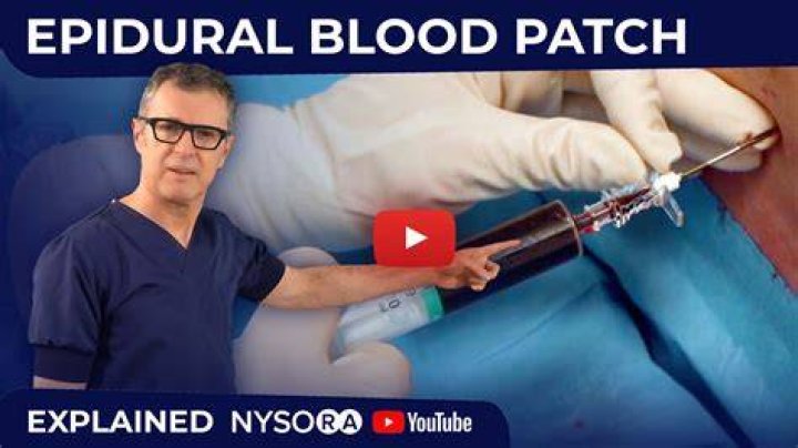 How can I avoid tearing during an epidural?