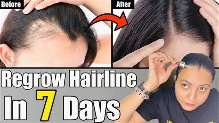 How can I regrow my hairline?