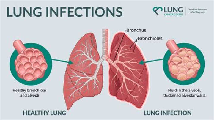 How can you tell if you have a lung infection?