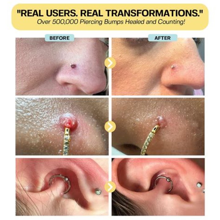 How do I treat a keloid on my ear piercing at home?