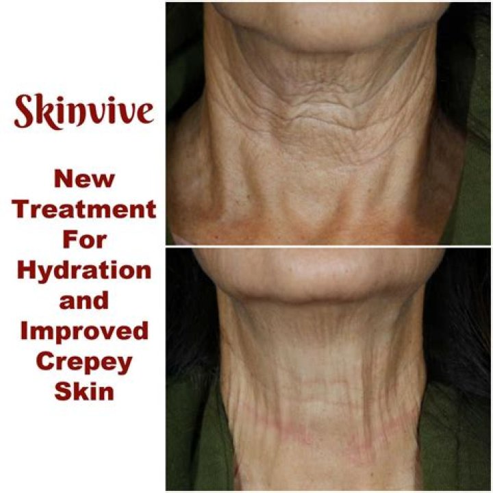 How do you get rid of Crepey skin naturally?