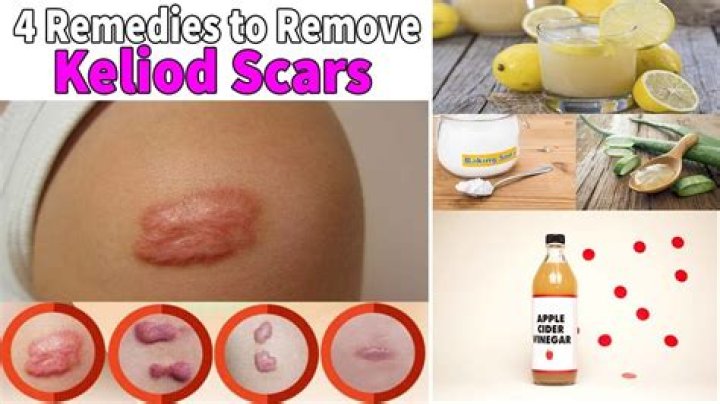 How do you make a keloid shot less painful?