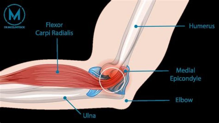How do you prevent Thrower elbow?