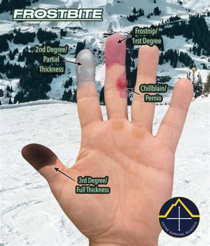 How do you soothe Frostnip?