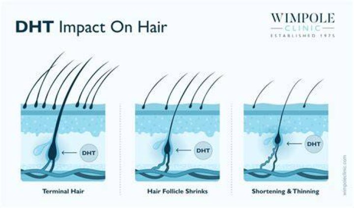 How do you stop DHT from attacking hair follicles?
