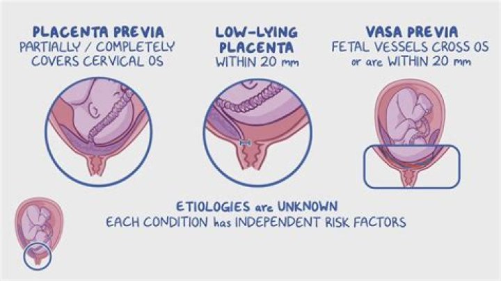 How do you treat placenta in goats?