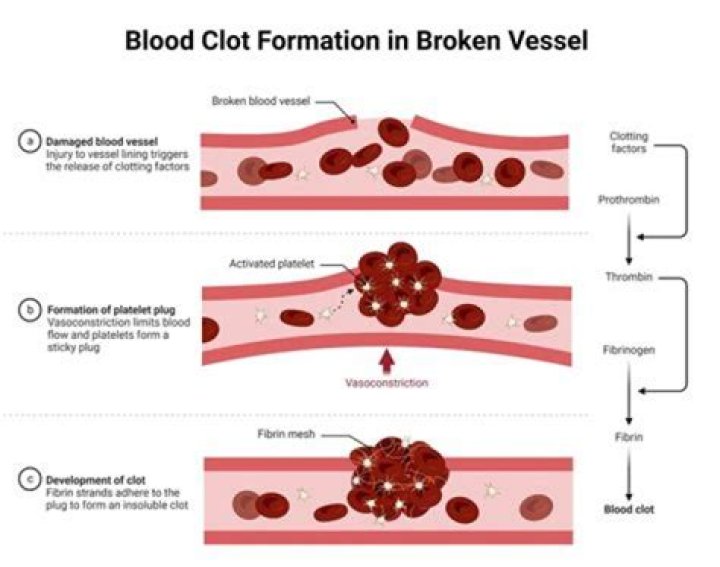 How does it feel when a blood clot moves up the vein?