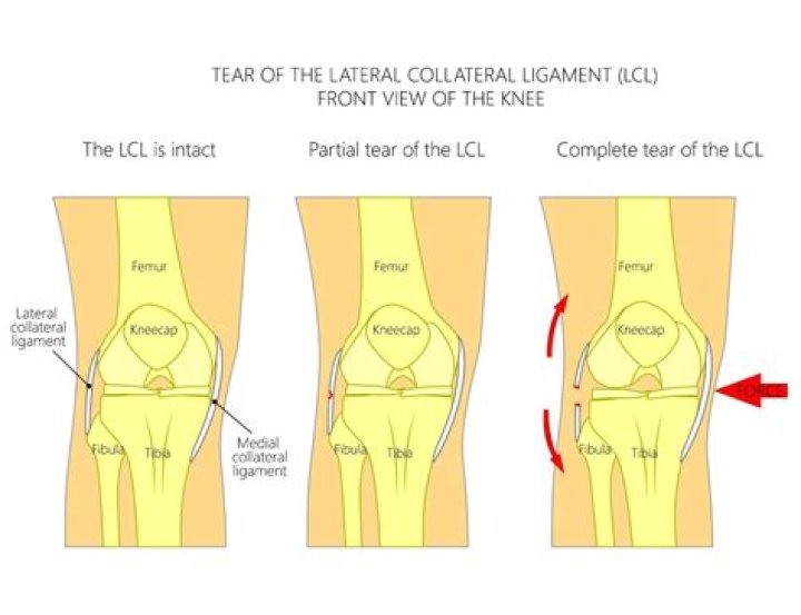 How long are you out if you tear your LCL?