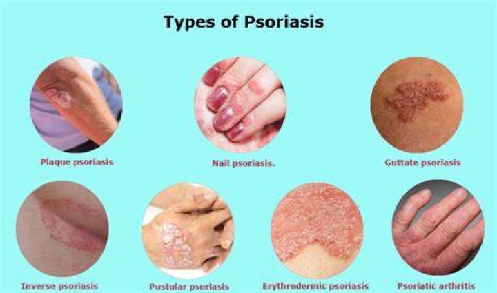 How long do psoriasis flare ups last?