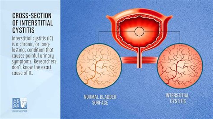 How long does interstitial cystitis last?