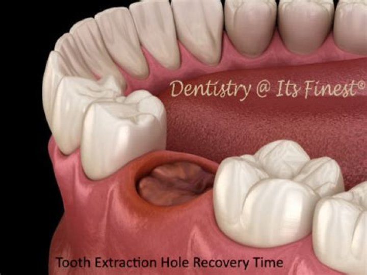 How long does it take the hole to close after tooth extraction?