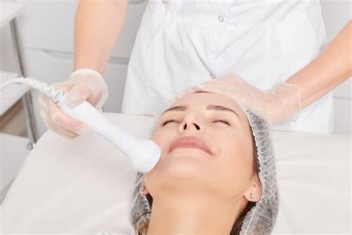 How long does RF skin tightening last?