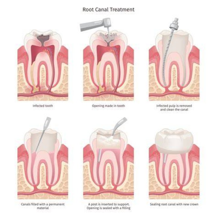 How many times can you have root canal on the same tooth?