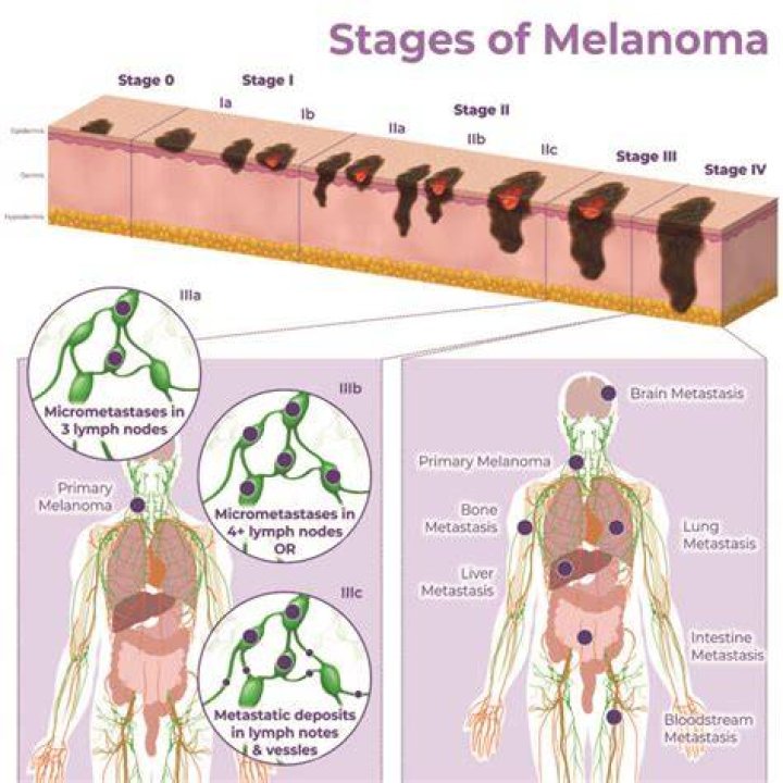 How quickly does melanoma spread?