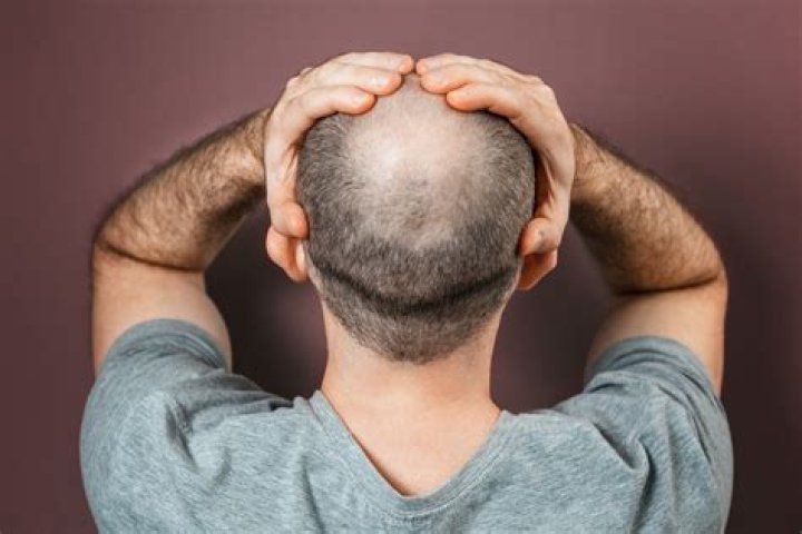Is being bald good for your health?