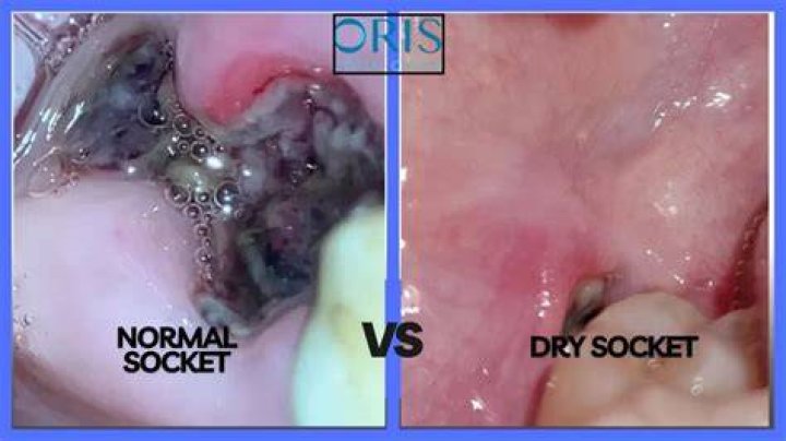 Is dry socket more common on top or bottom?