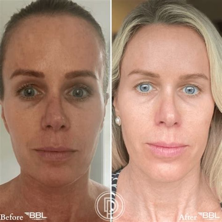 Is one BBL treatment enough?
