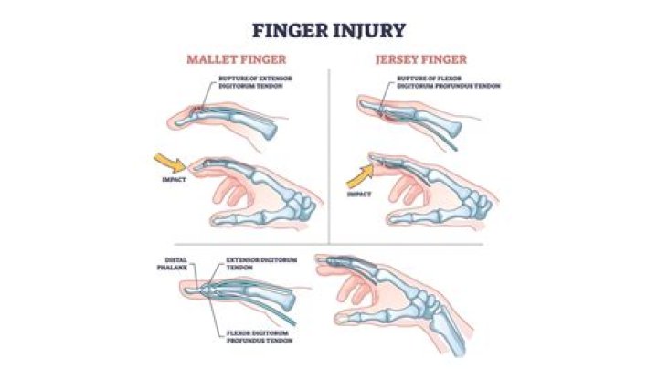 Should you ice a smashed finger?