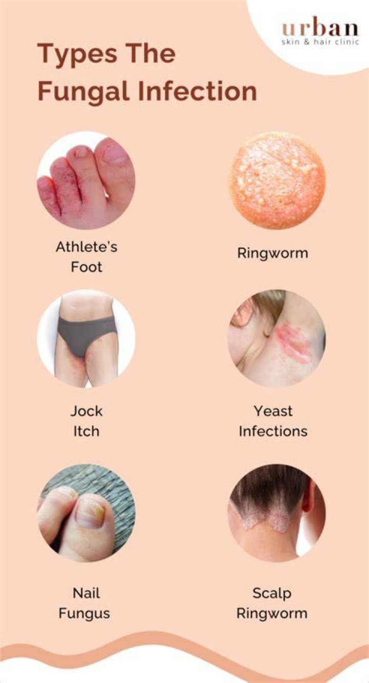 What are 3 fungal infections?