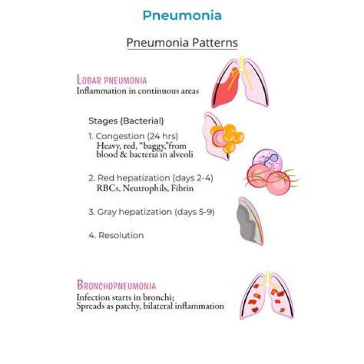 What are the 4 stages of pneumonia symptoms?