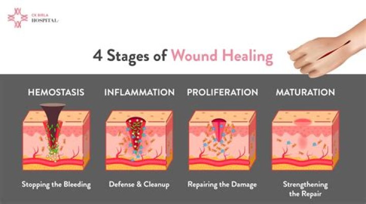 What are the four physical stages of wound healing?