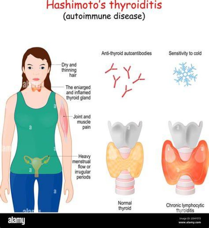What autoimmune disease destroys the thyroid?
